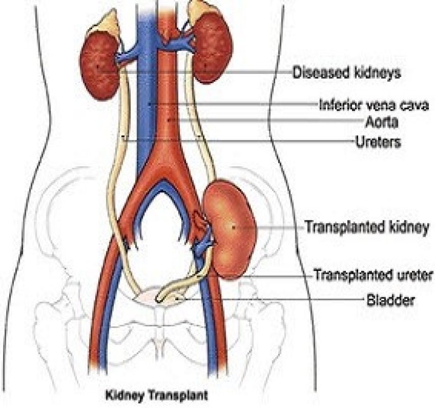 recipient-surgery